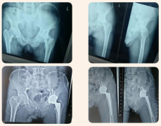 【醫訊】臨滄市中醫醫院骨科成功開展全髖關節置換術
